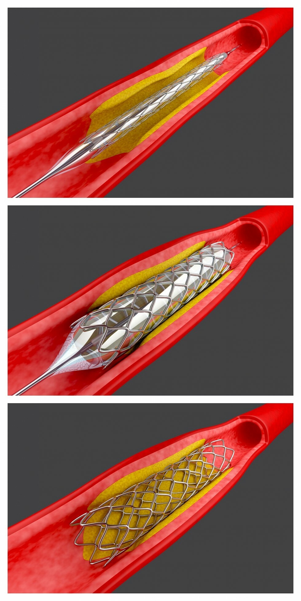 Angioplasty procedure model